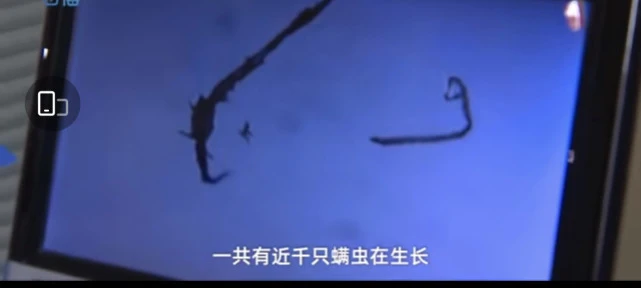 一女生睫毛滋生上千只螨虫，究竟是因为宠物还是另有隐情？