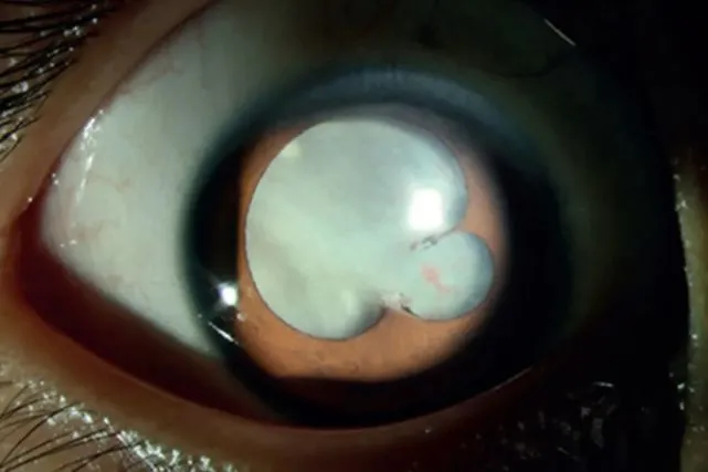 8岁男孩全眼近盲，只因和“它”亲密接触，家长：大意了…