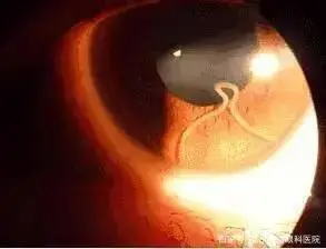 2岁女童眼睛发痒，医生从眼睛里掏出6条蠕动的虫…