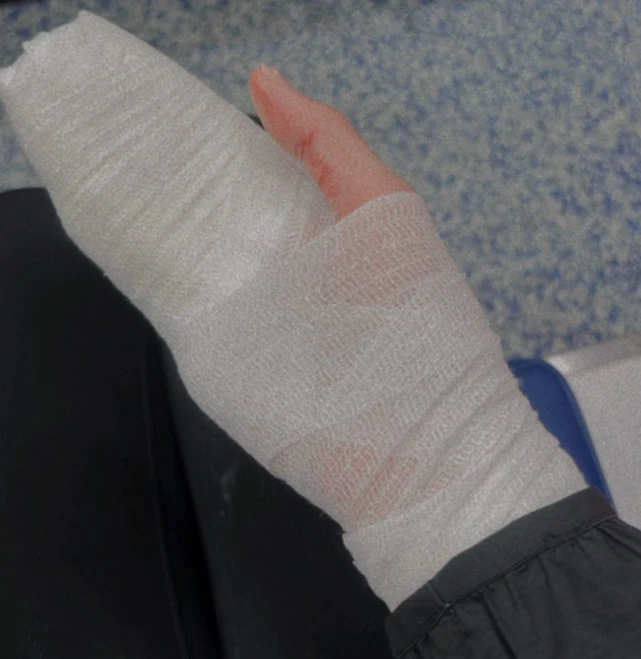 28岁女星邓美欣被狗咬，住院2周做4次手术，狗主人拒绝承担责任