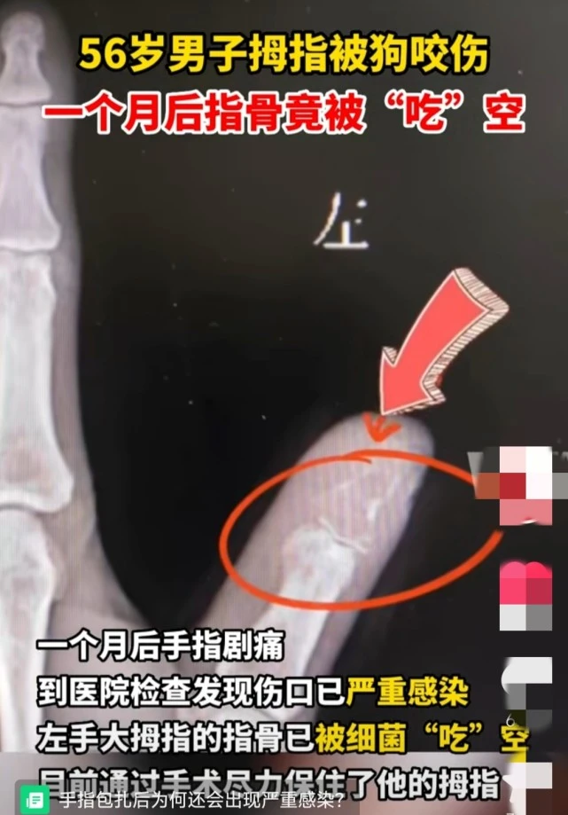 一男子被狗咬伤拇指，一个月后发现指骨被“吃”空，原因让人唏嘘