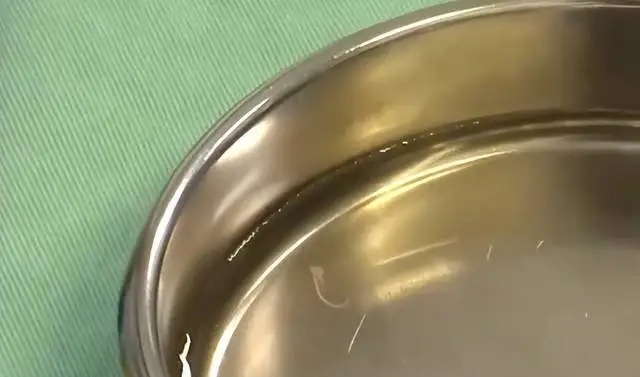 2岁男童的眼睛，发现4条寄生虫游动！曾有犬类密切接触史