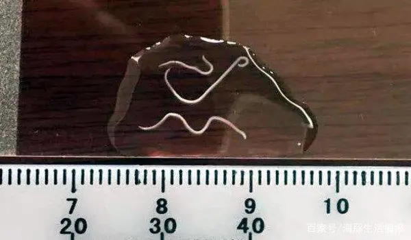 男童眼中发现4条活虫，这些虫子是什么，怎么进入人眼中的？